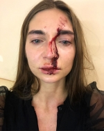 Избитая косметологом Олесей Соколан пациентка