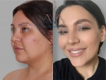 Омоложение лица FaceTite. Доткор Вардан Аршакян